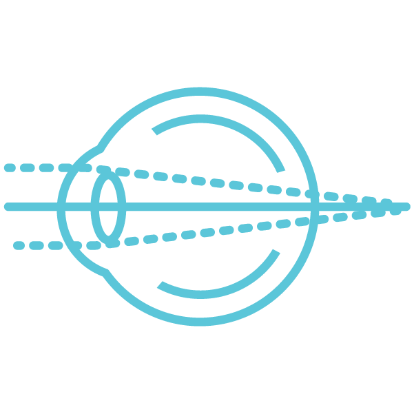 Schéma explicatif presbytie