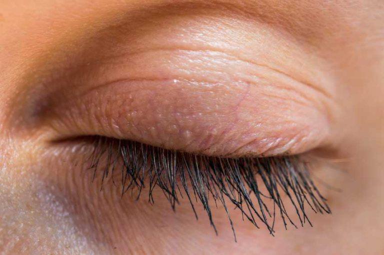 Soigner les pathologies des paupières Entropion et Ectropion