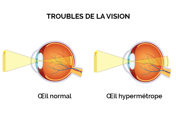 Zoom sur le trouble de vision - Hypermétropie