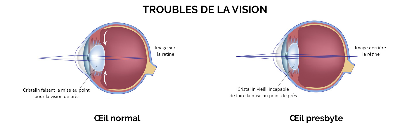 Prendre un RDV ophtalmologique à Osny - Presbytie