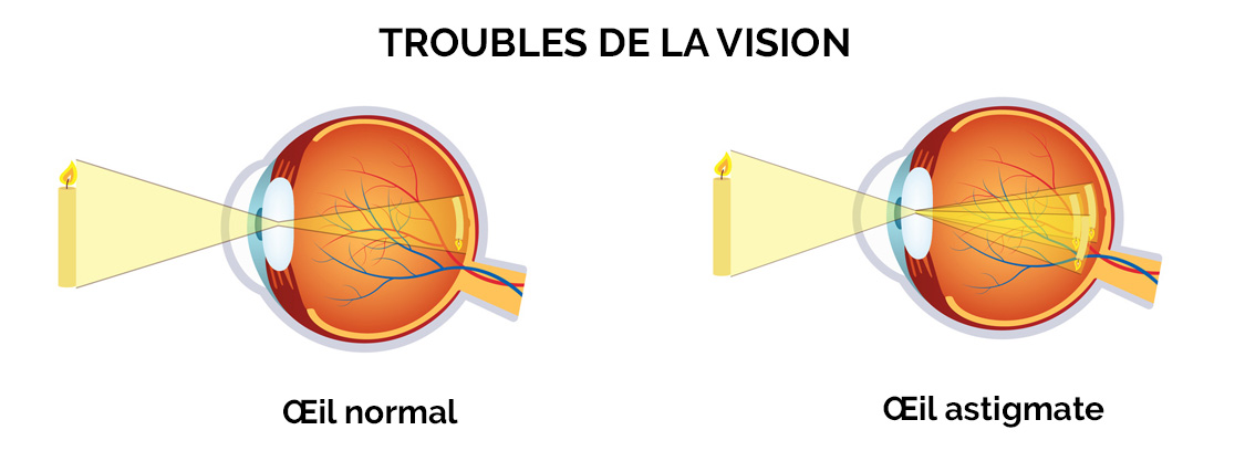 Quels symptômes lorsque l'on est astigmate ? COVO 95