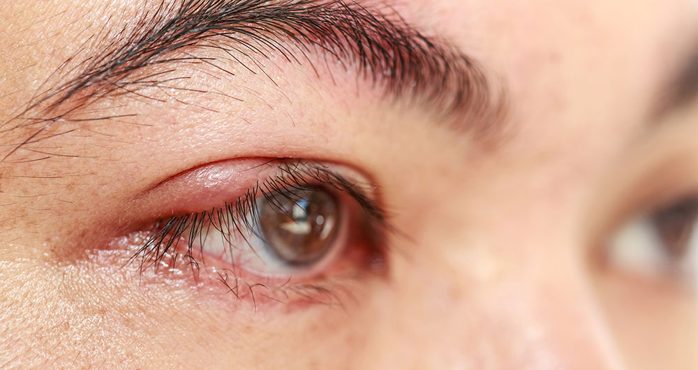 Tout savoir sur le chalazion - COVO 95